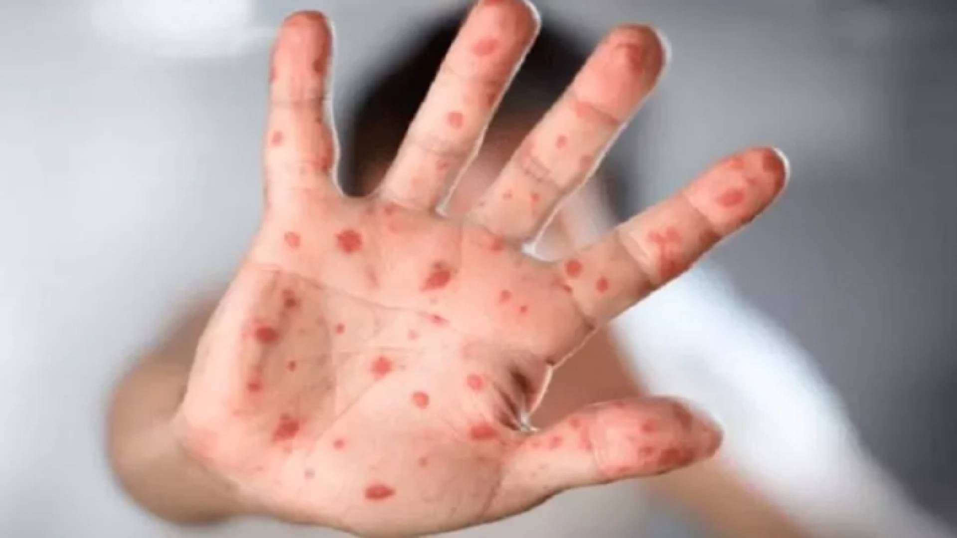 يد شخص مصاب بجدري القرود