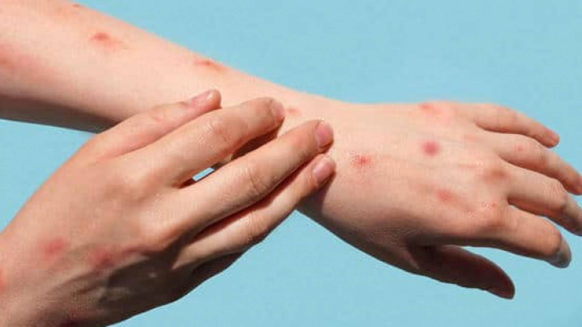 شخص يعاني من طفح جلدي بسبب جدري القرود