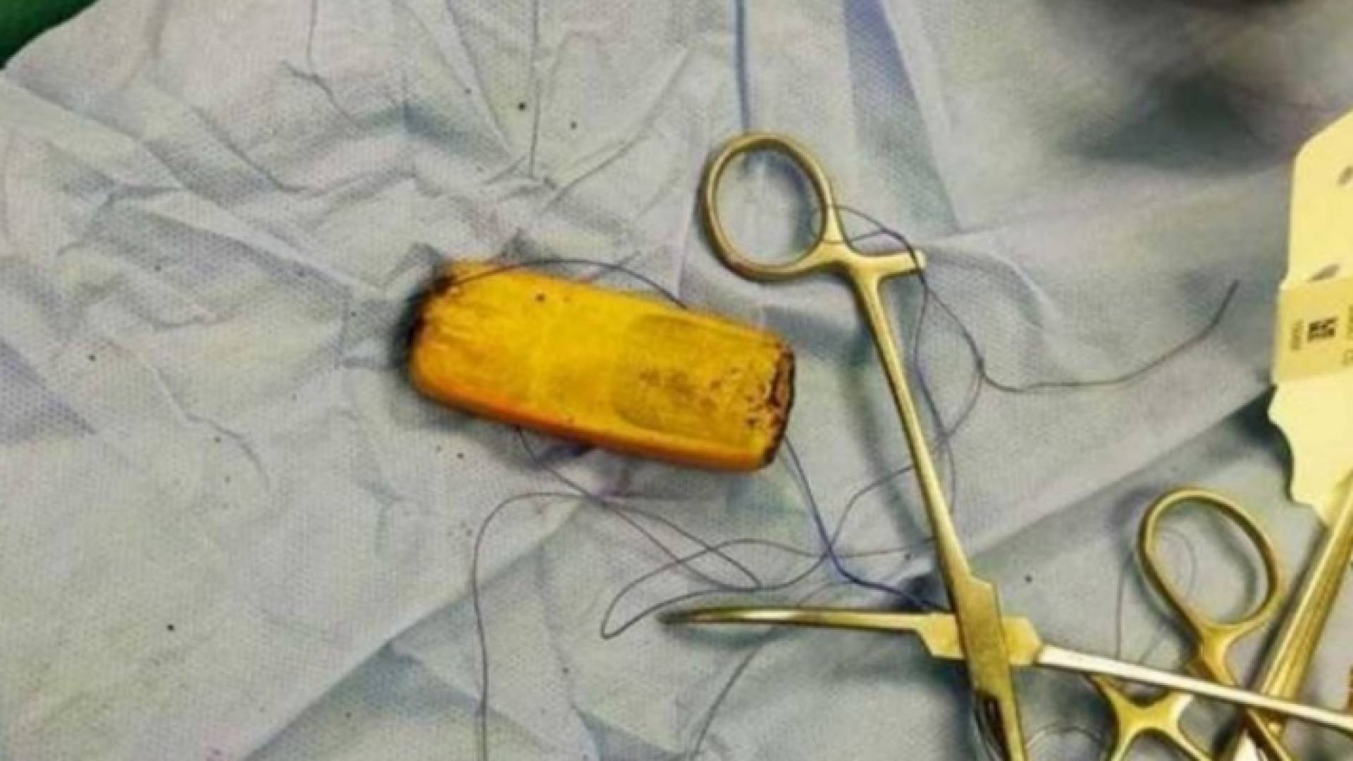 "الموبايل" بعد استخراجه من معدة الشاب