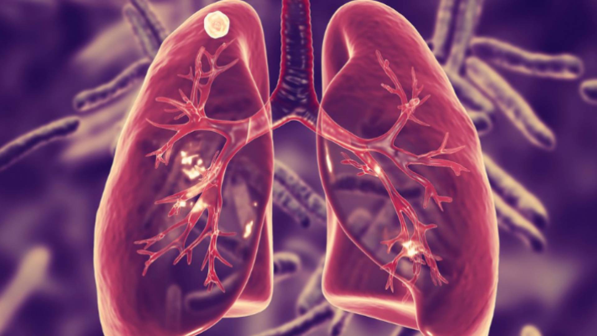 صورة توضيحية لرئتي مريض مصاب بداء السل