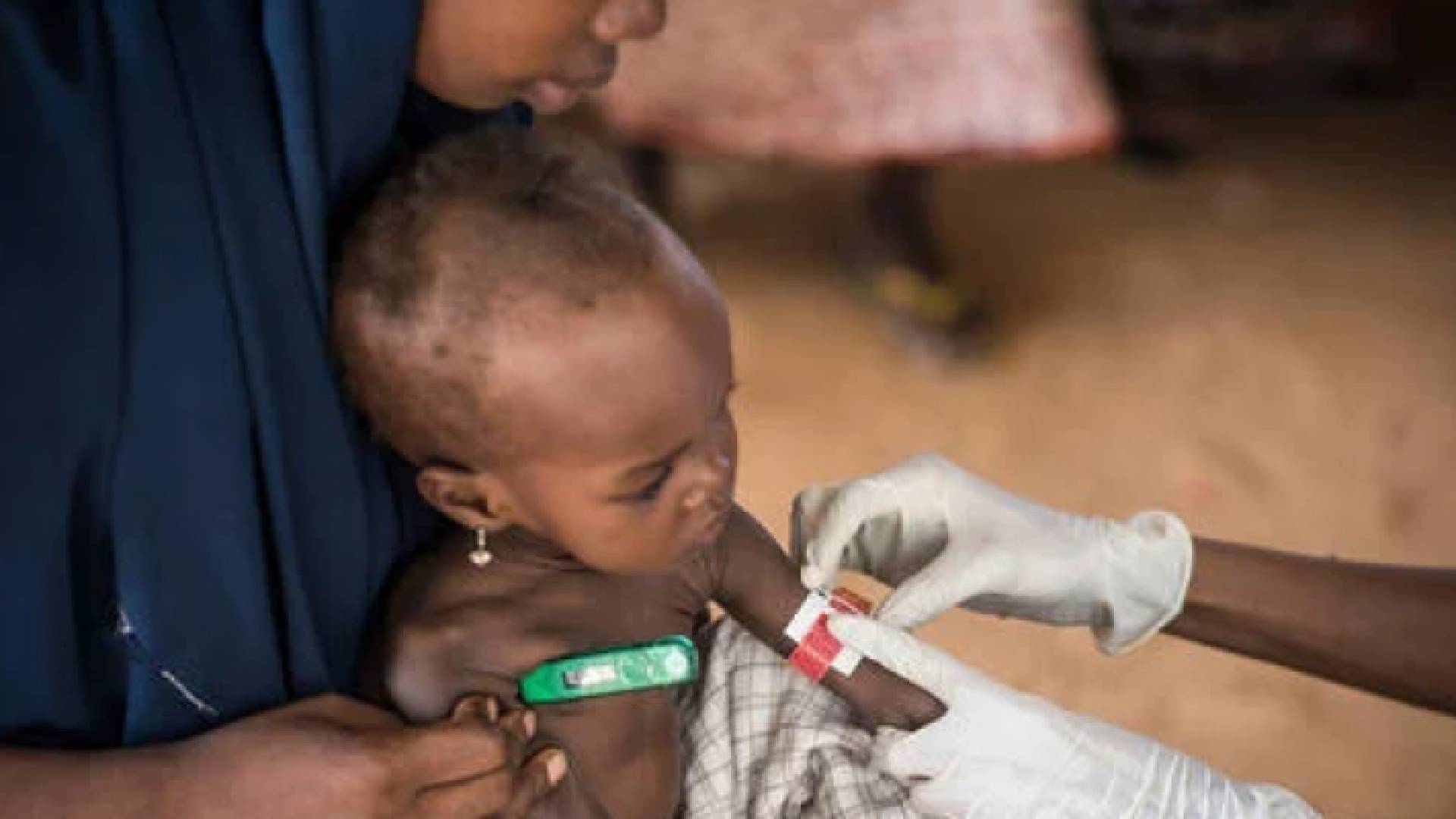 طفل يعاني من نقص التغذية - أرشيفية