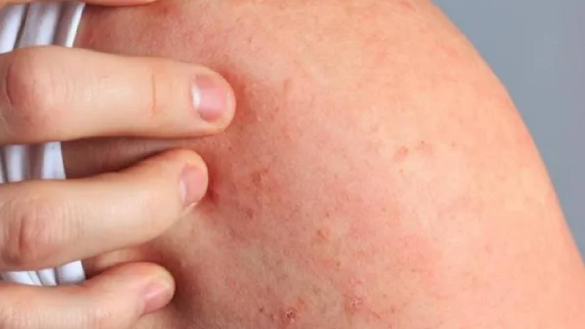 شخص مصاب بالجرب - توضيحية