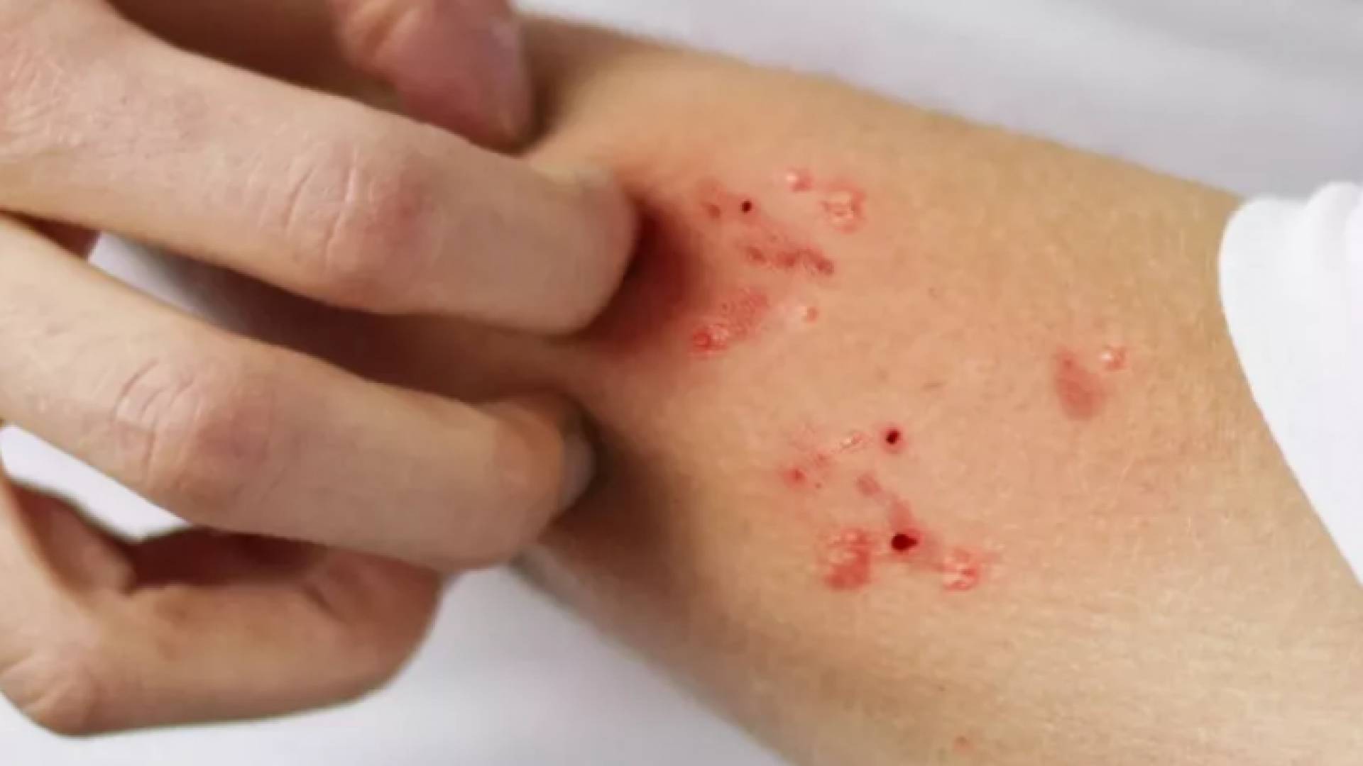 شخص مصاب بالجرب "تعبيرية"