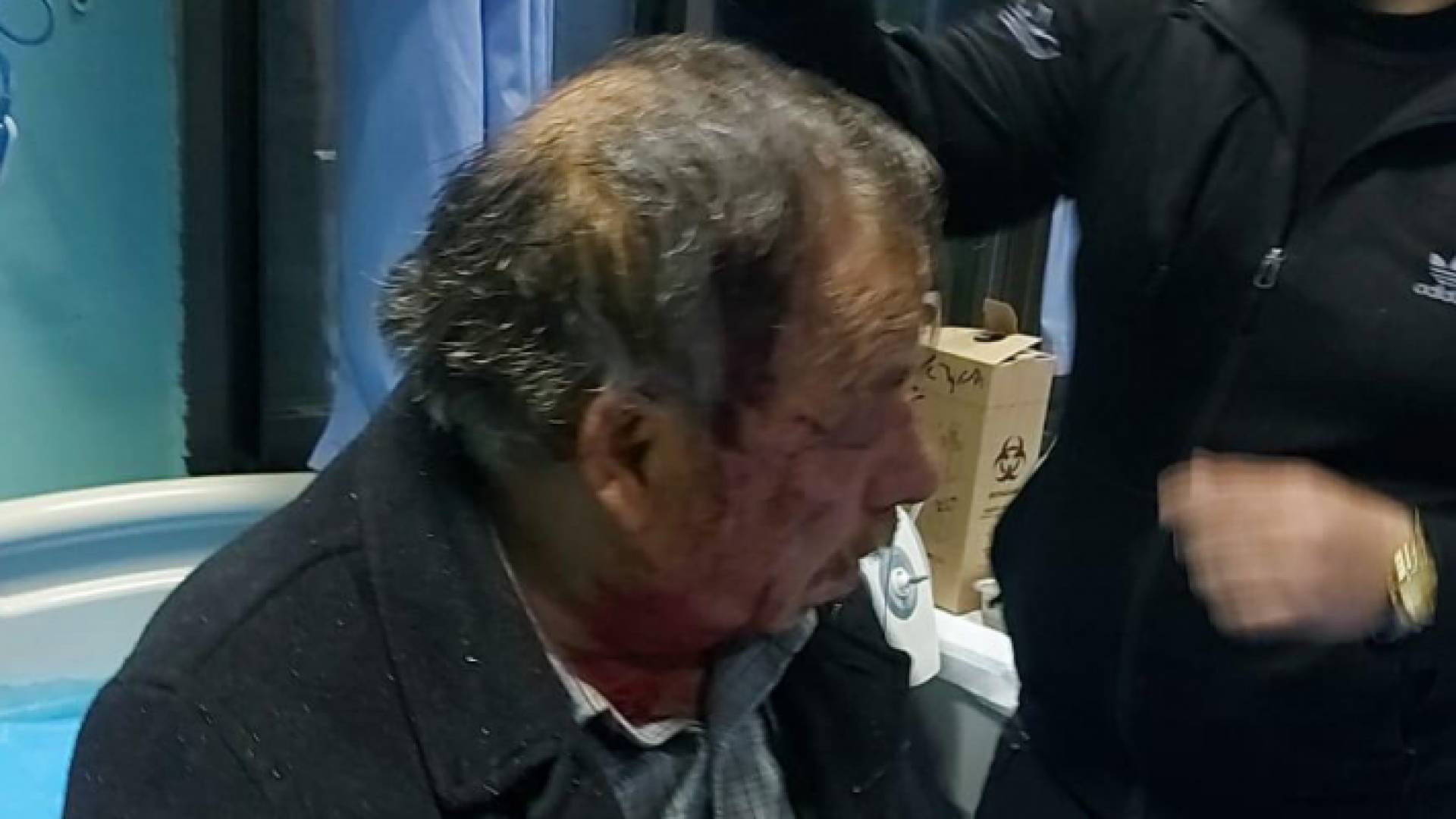 أحد الفلسطينيين المصابين بحجارة المستوطنين في حوارة