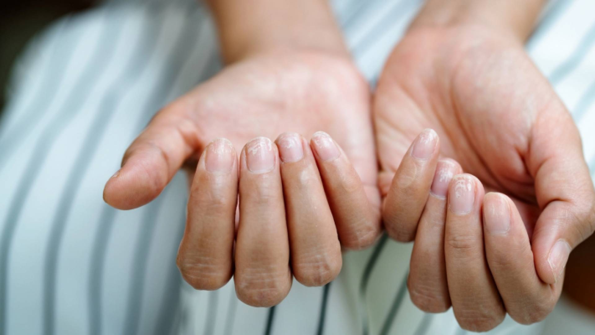 أظافر غير صحية