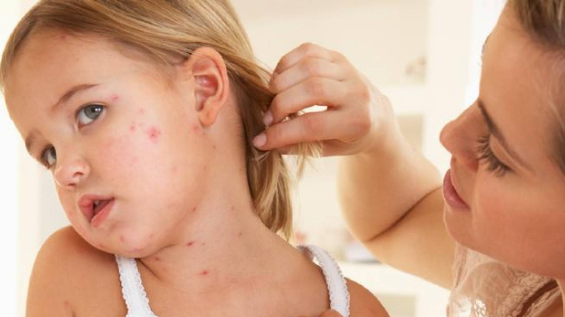 طفلة مصابة بعدى الحصبة