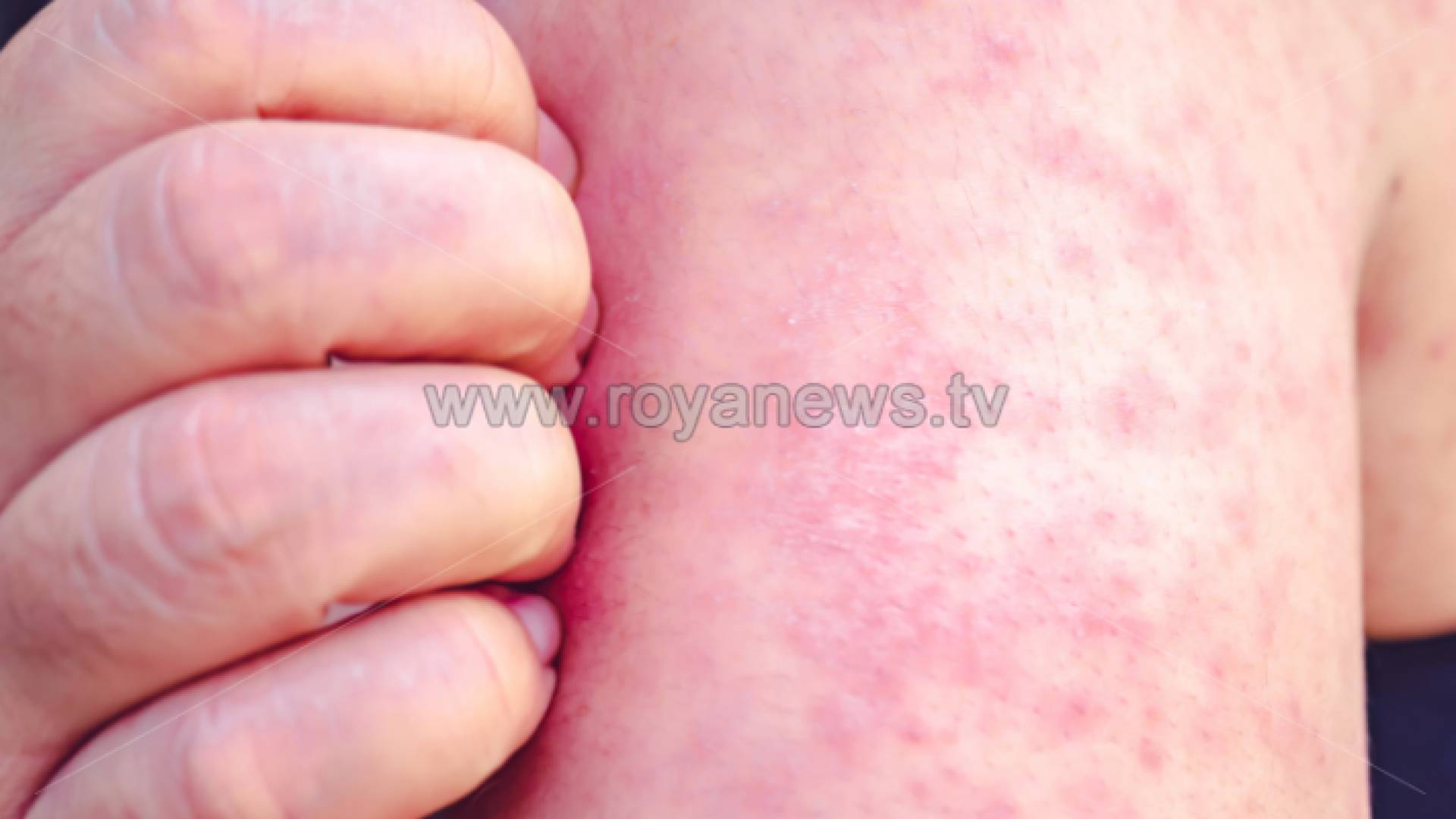 شخص مصاب بالحصبة "أرشيفية"