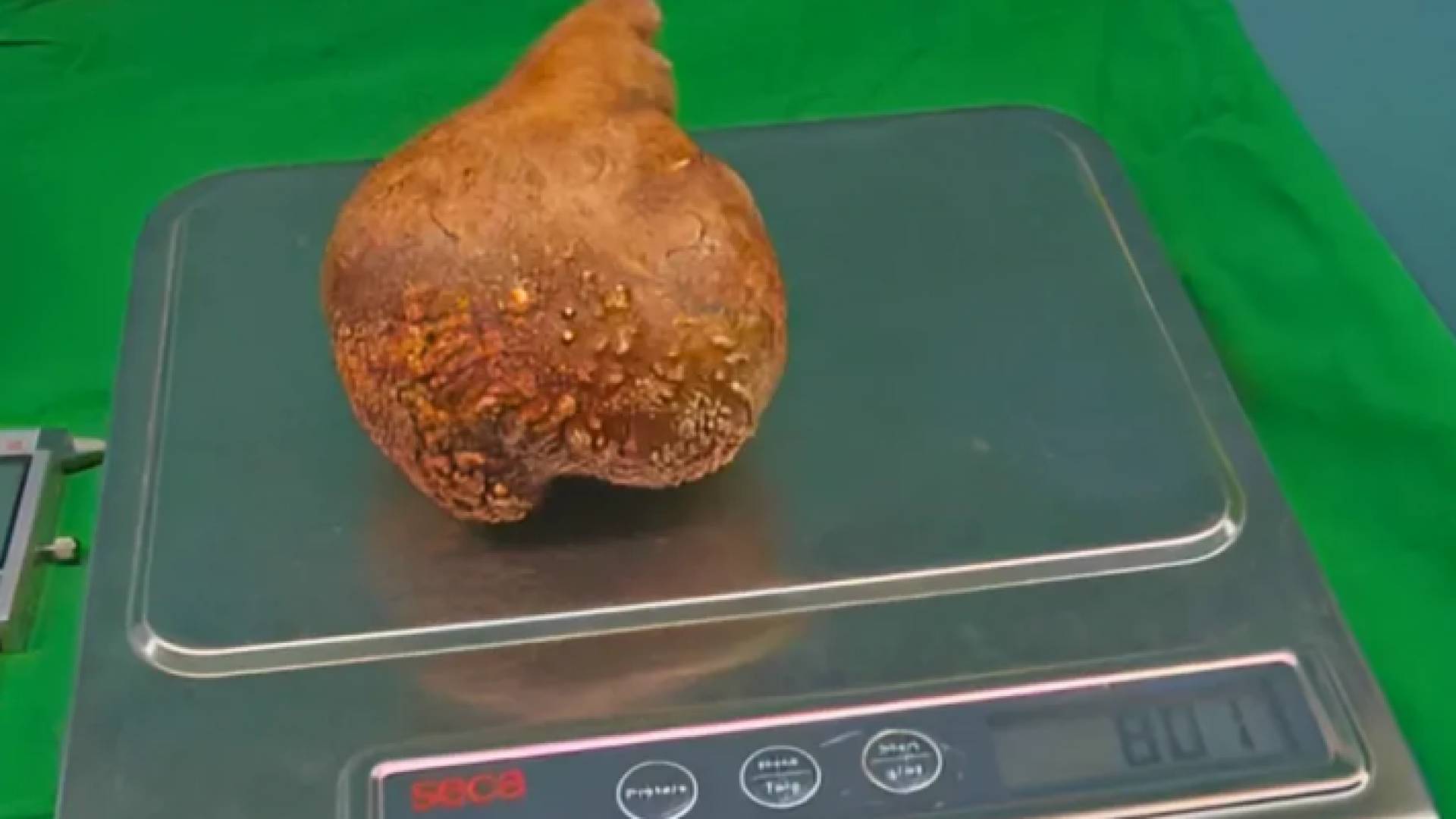 الحصوة التي تم استئصالها