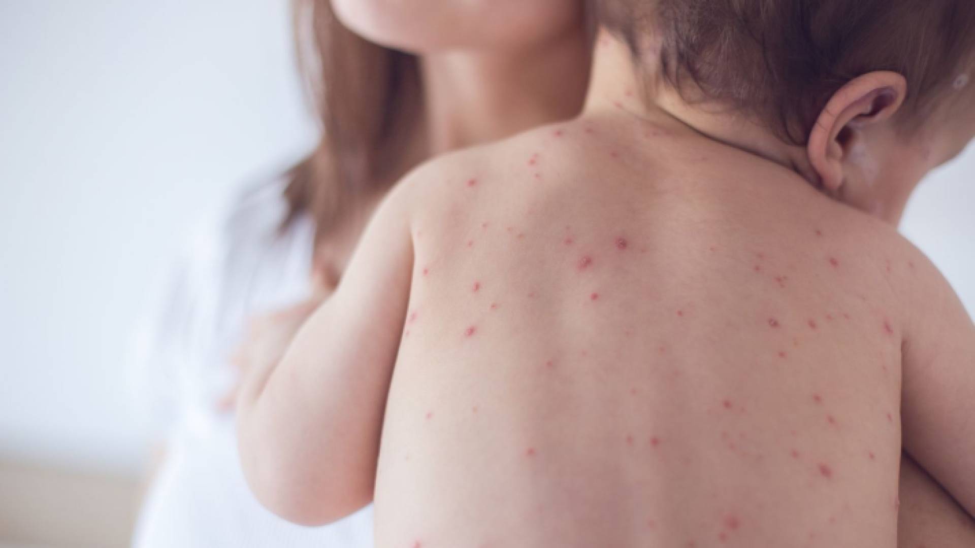 طفل مصاب بالحصبة