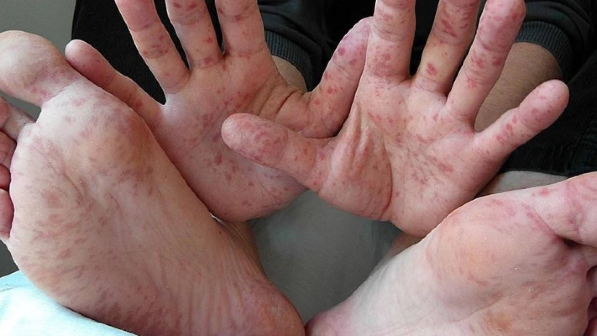 شخص يظهر عليه طفح جلدي لمعاناته من الحمى القلاعية