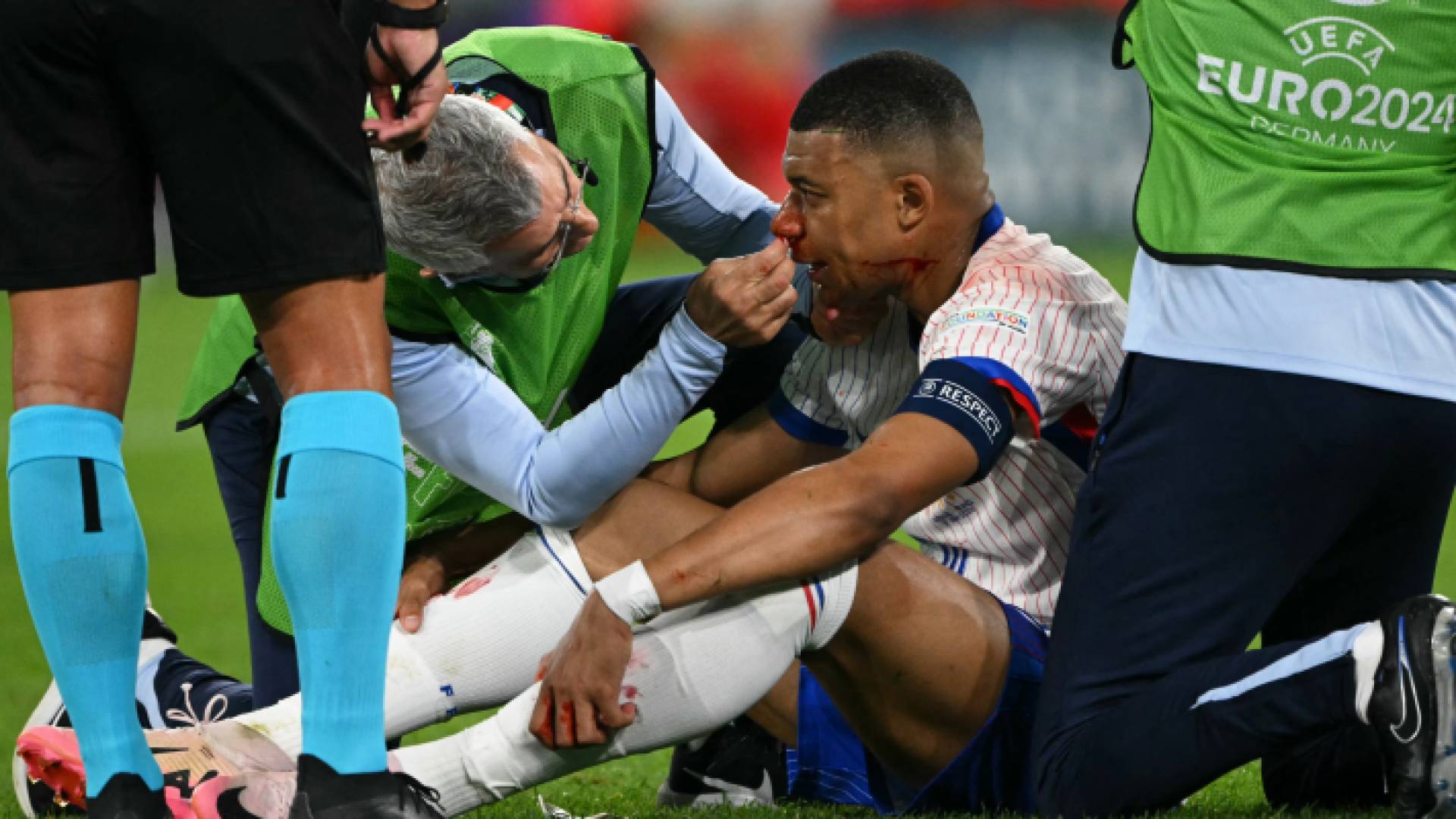 قائد المنتخب الفرنسي مبابي بعد تعرضه لكسر بالأنف