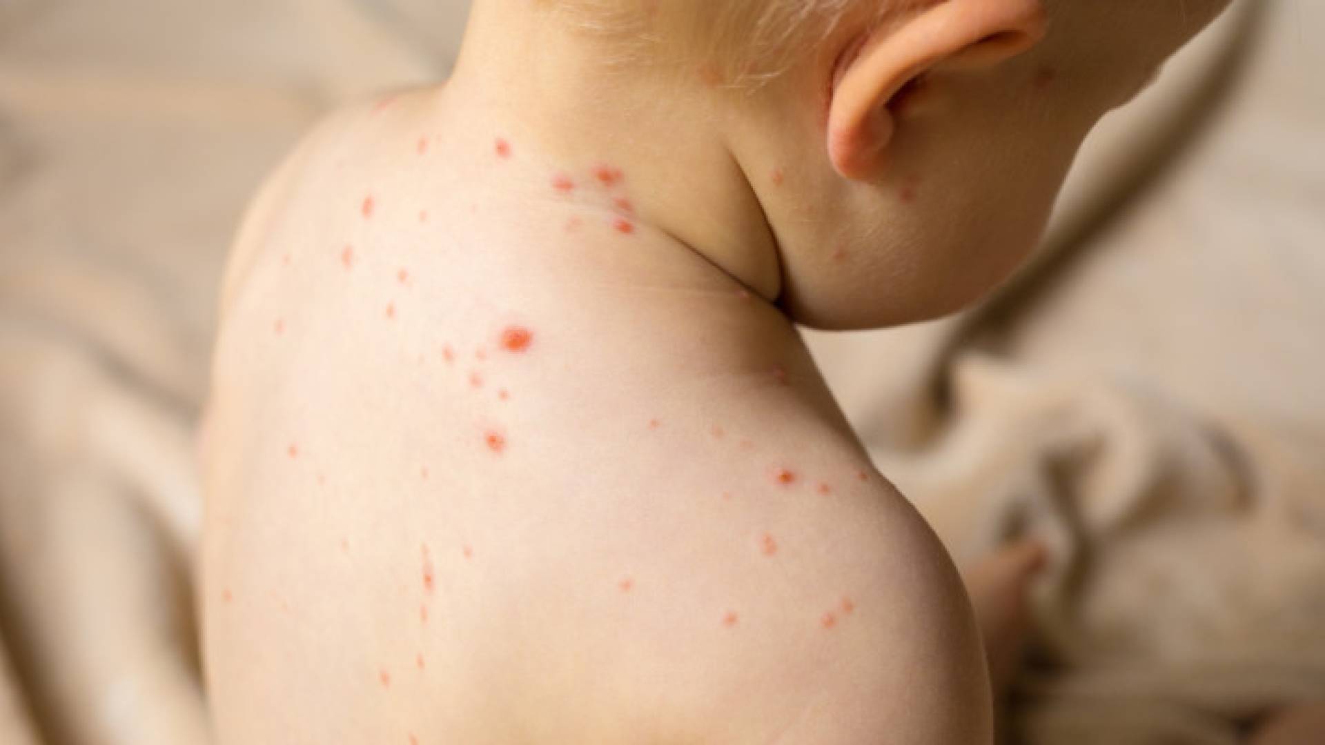 صورة تعبر عن إصابة طفل بالجدري