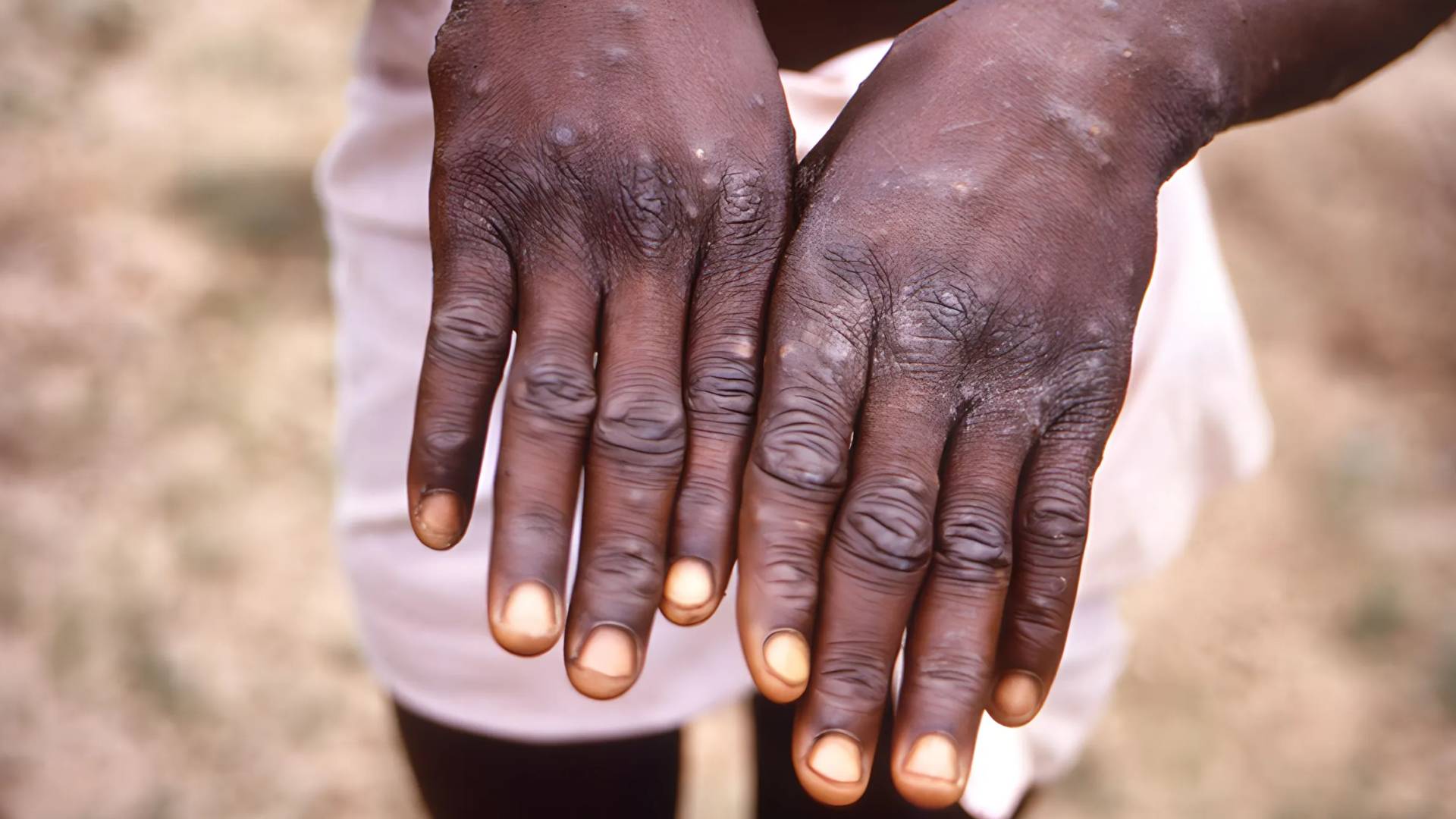 جدري القردة - تعبيرية