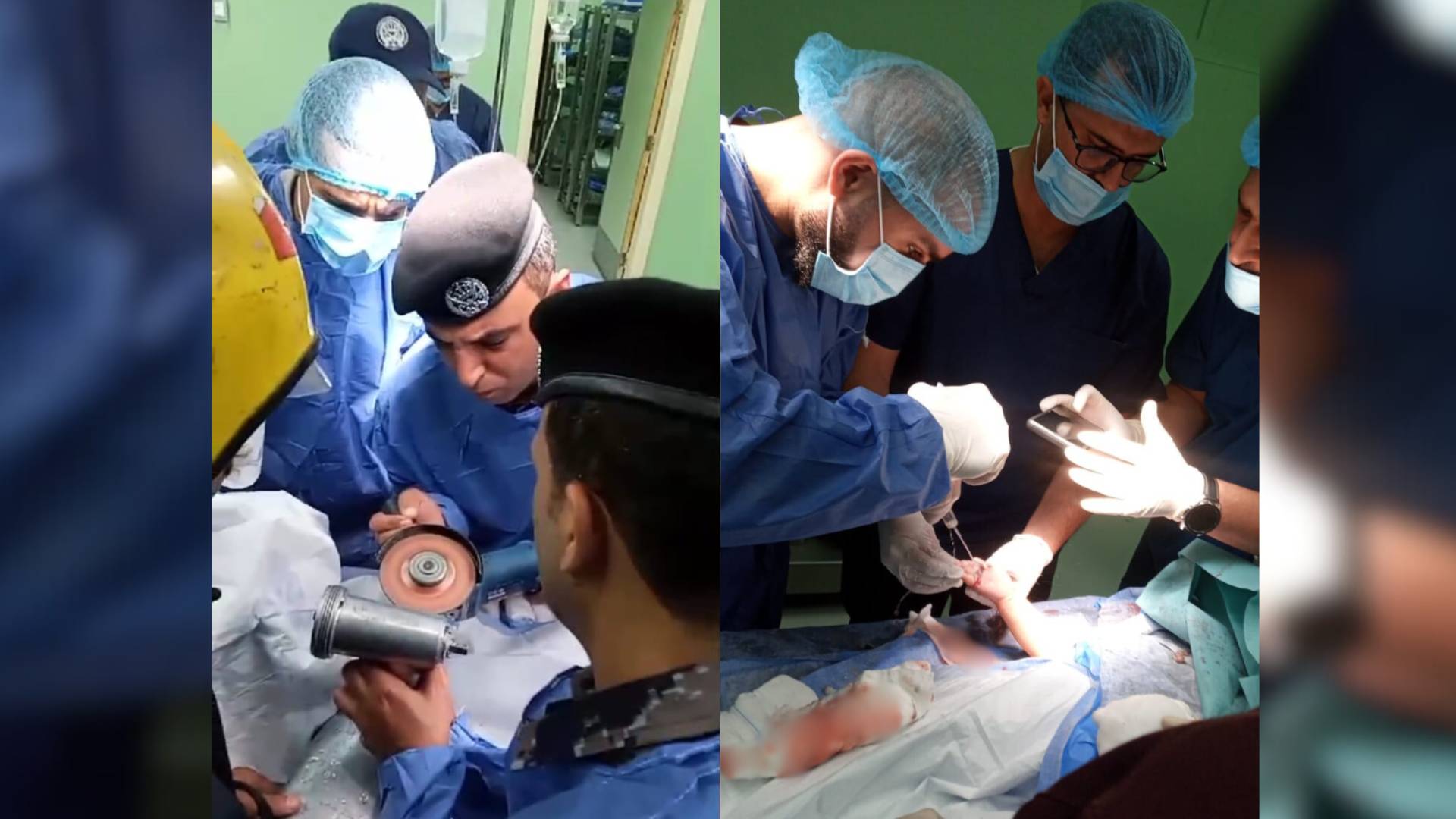 إجراء عملية لانقاذ الطفلة