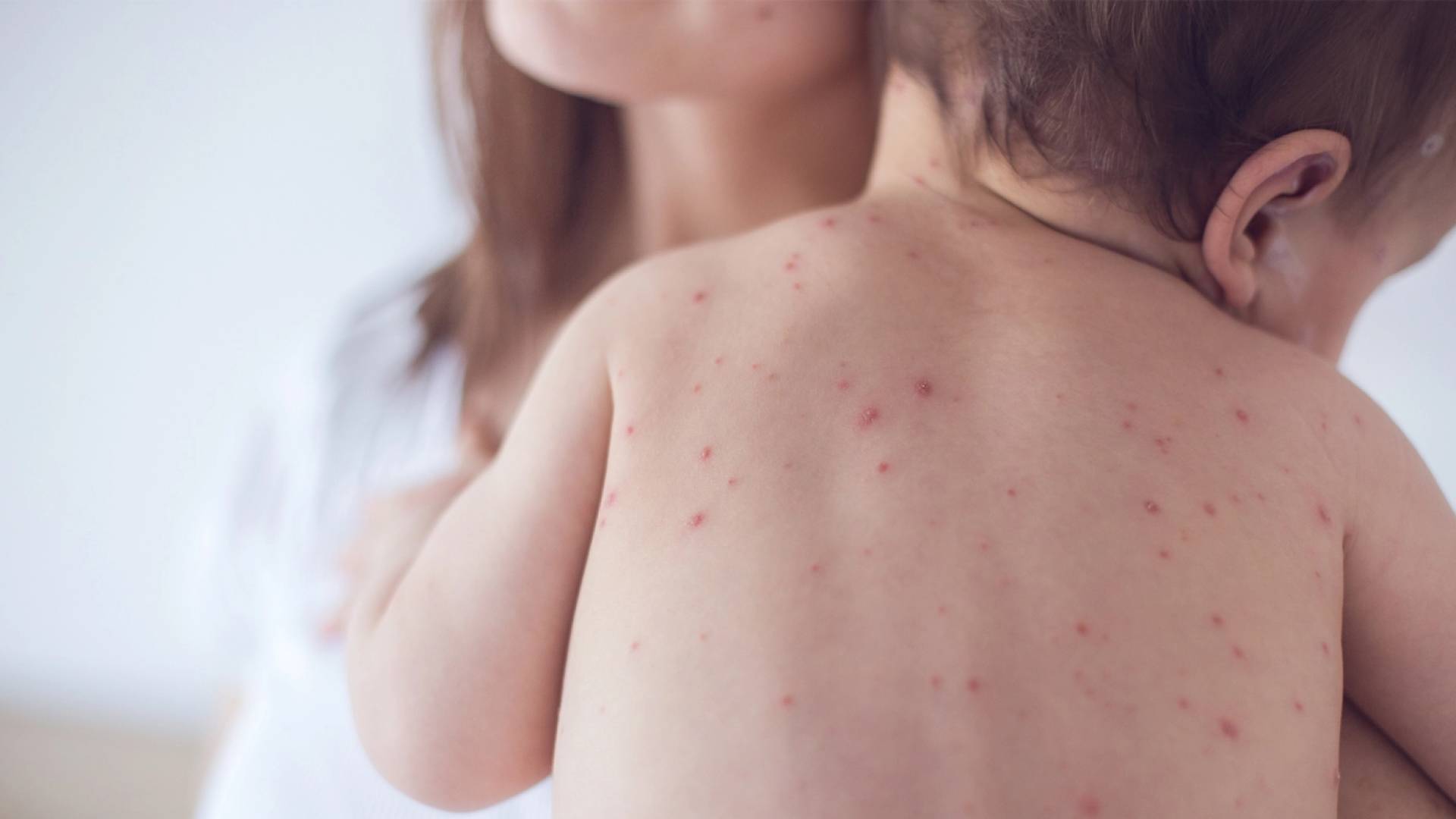 إصابة بالحصبة