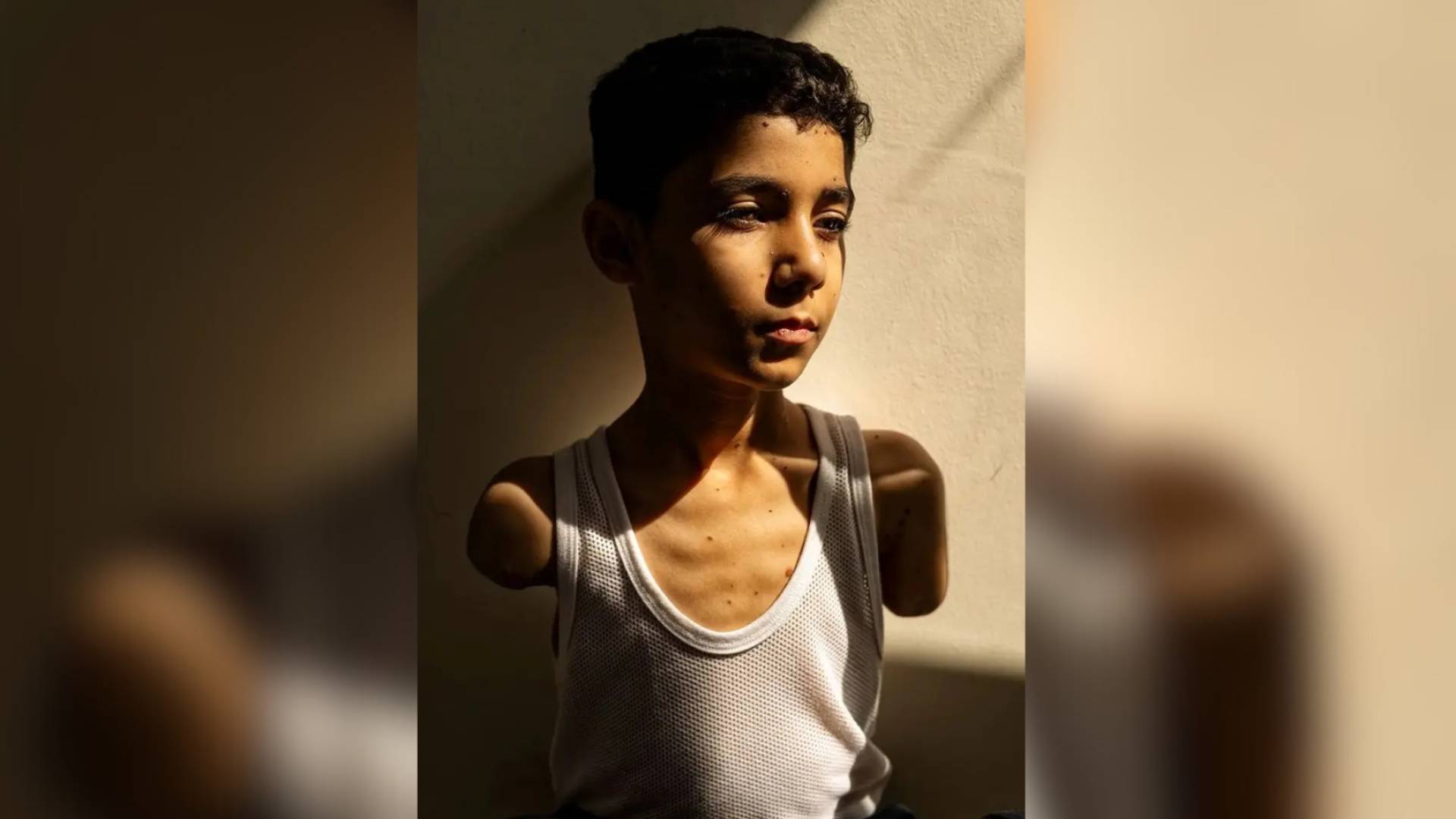 صورة التقطتها الصحافية سمر أبو العوف لطفل فقد ذراعيه خلال عدوان الاحتلال