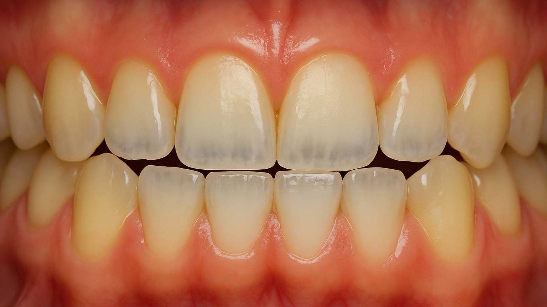 أسنان - تعبيرية