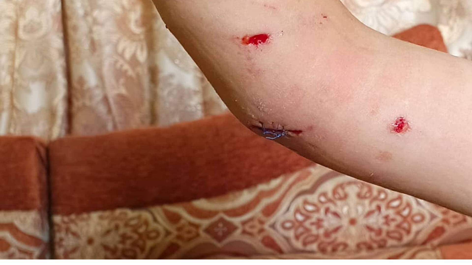 إصابة 4 مواطنين وعقر كلاب ضالة إثر هجوم لكلب مسعور في مادبا